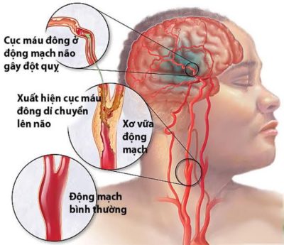 Tai biến mạch máu não