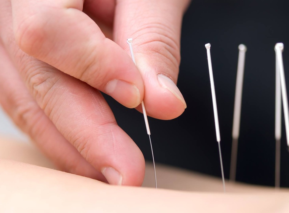 Điện châm chữa viêm quanh khớp vai