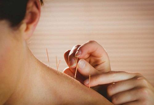 Điện châm chữa đau vai gáy