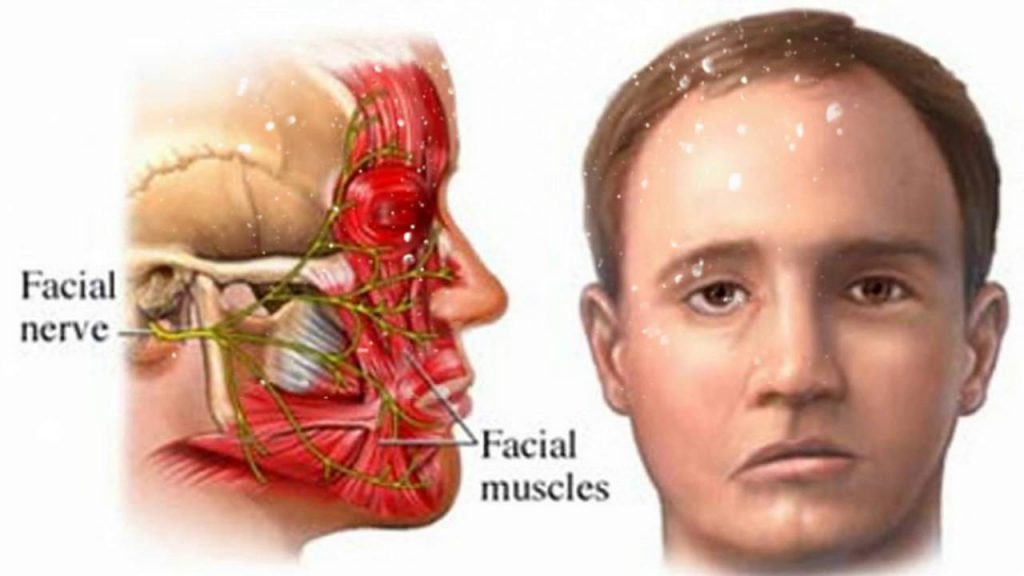 Nghiên cứu sự thay đổi trên điện cơ và lâm sàng bệnh liệt thần kinh VII ngoại biên do lạnh