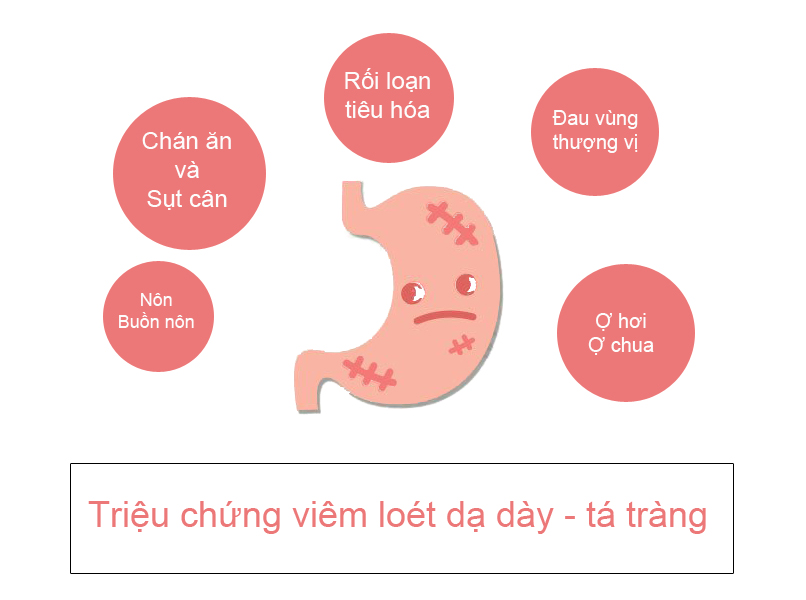 Điều trị hội chứng dạ dày- tá tràng bằng phương pháp cấy chỉ