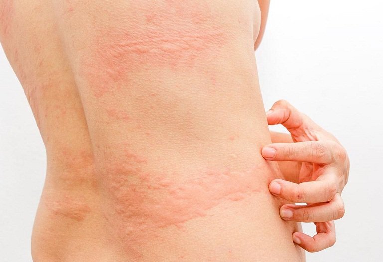 Cấy chỉ điều trị bệnh mày đay hiệu quả