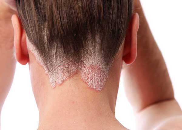 Xóa tan nỗi lo bệnh vẩy nển nhờ Cấy chỉ