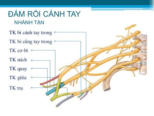 Cấy trỉ điều trị liệt tay do tổn thương đám rối thần kinh tay