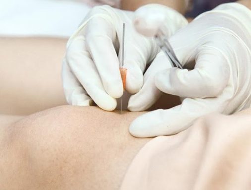 Cấy chỉ điều trị chậm phát triển trí tuệ ở trẻ bại não