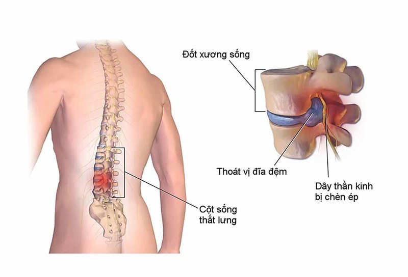 Cấy chỉ điều trị hội chứng thắt lưng hông