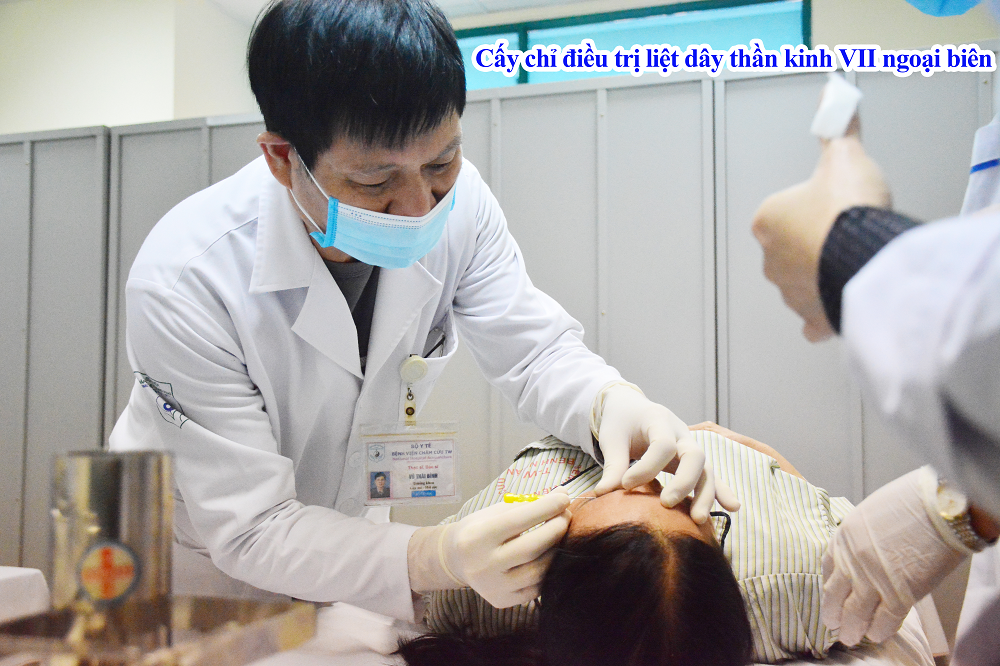 Cấy chỉ điều trị liệt dây thần kinh VII ngoại biên