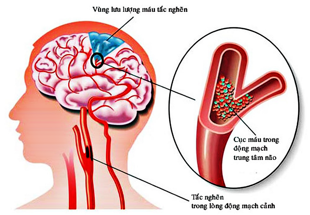 Cấy chỉ điều trị hội chứng đau đầu khác (Thiểu năng tuần hoàn não mạn tính)