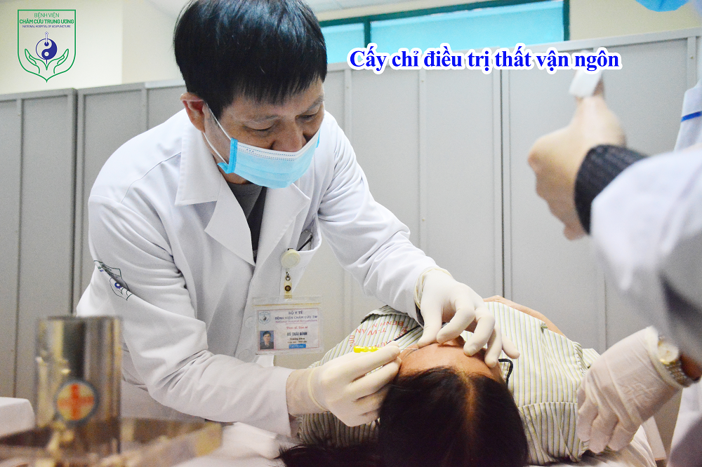 Cấy chỉ điều trị thất vận ngôn