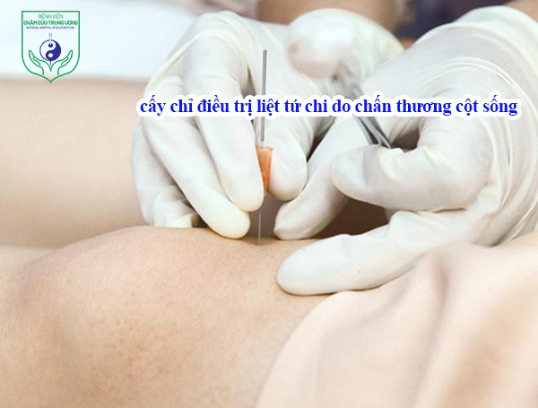 Cấy chỉ điều trị liệt tứ chi do chấn thương cột sống