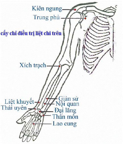 Cấy chỉ điều trị liệt chi trên