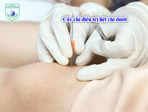 Cấy chỉ điều trị liệt chi dưới