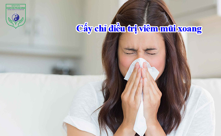 Cấy chỉ điều trị viêm mũi xoang