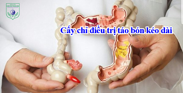 Cấy chỉ điều trị táo bón kéo dài