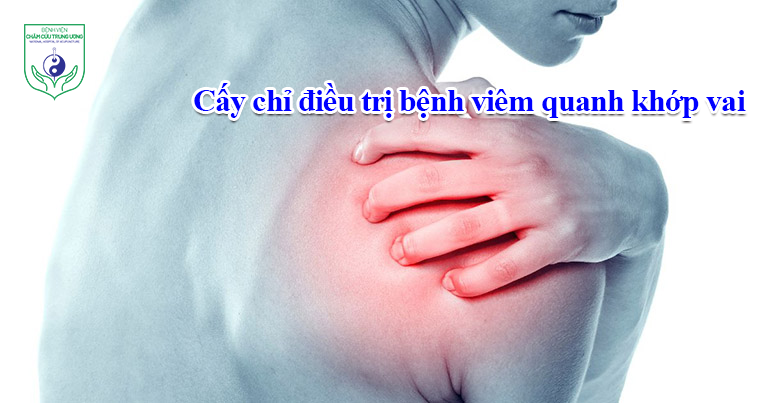 Cấy chỉ điều trị bệnh viêm quanh khớp vai