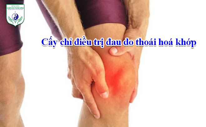 Cấy chỉ điều trị đau do thoái hoá khớp