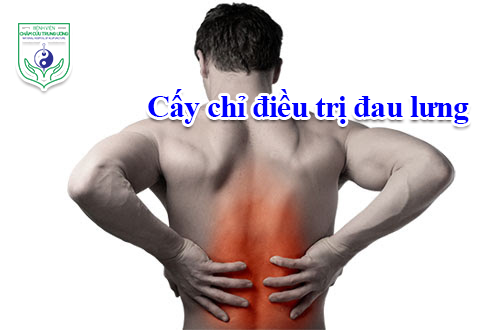 Cấy chỉ điều trị đau lưng