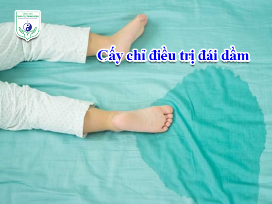 Cấy chỉ điều trị đái dầm