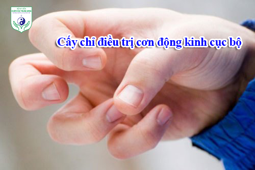 Cấy chỉ điều trị cơn động kinh cục bộ