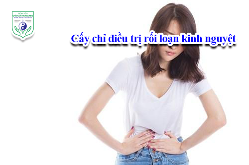 Cấy chỉ điều trị rối loạn kinh nguyệt