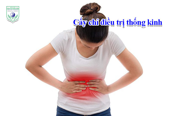 Cấy chỉ điều trị thống kinh