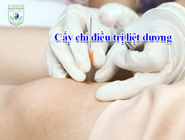 Cấy chỉ điều trị liệt dương