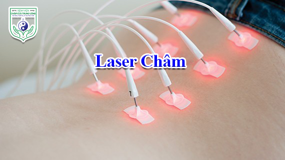 Laser Châm