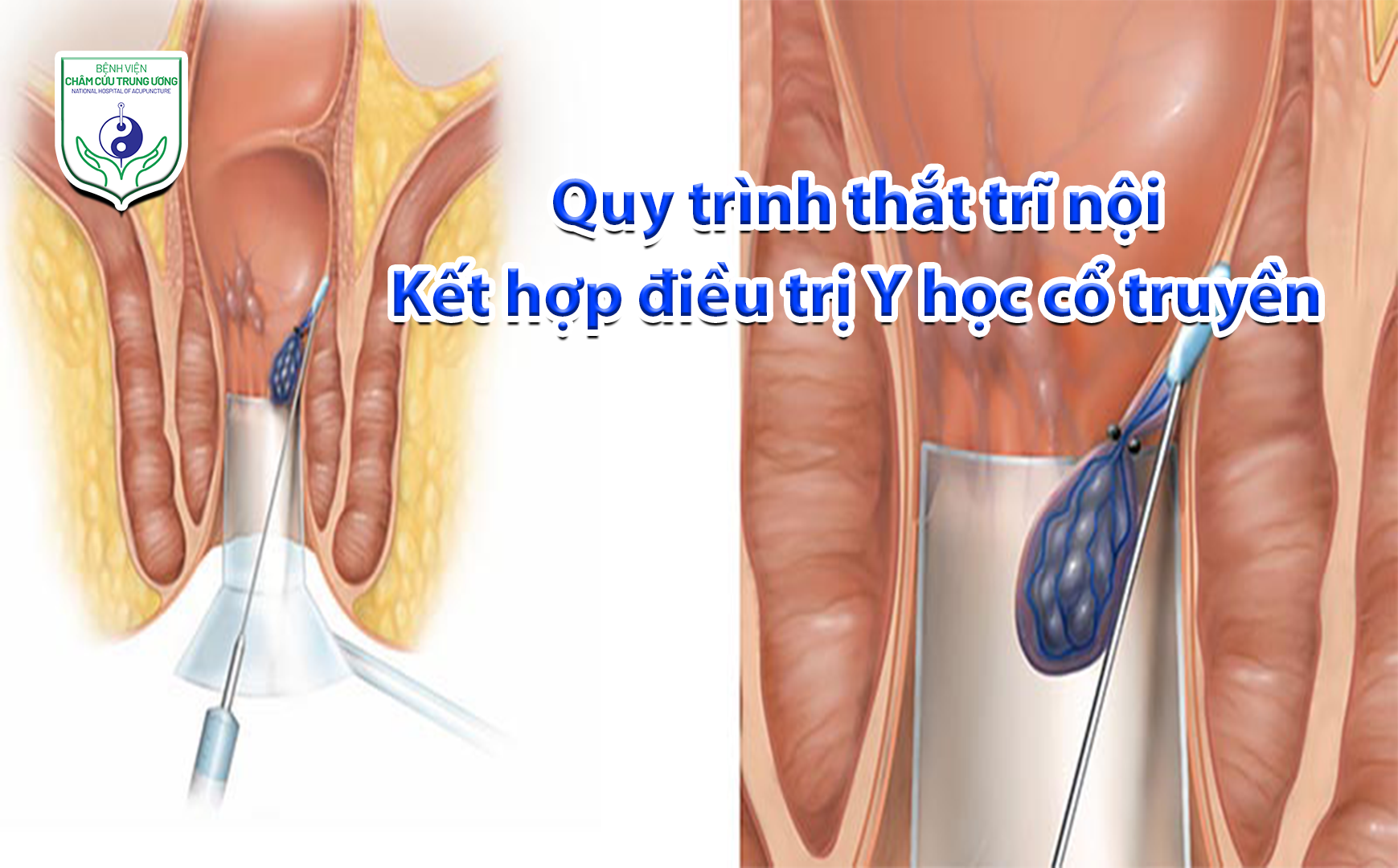 Quy trinh thắt trĩ nội - Kết hợp điều trị Y học cổ truyền