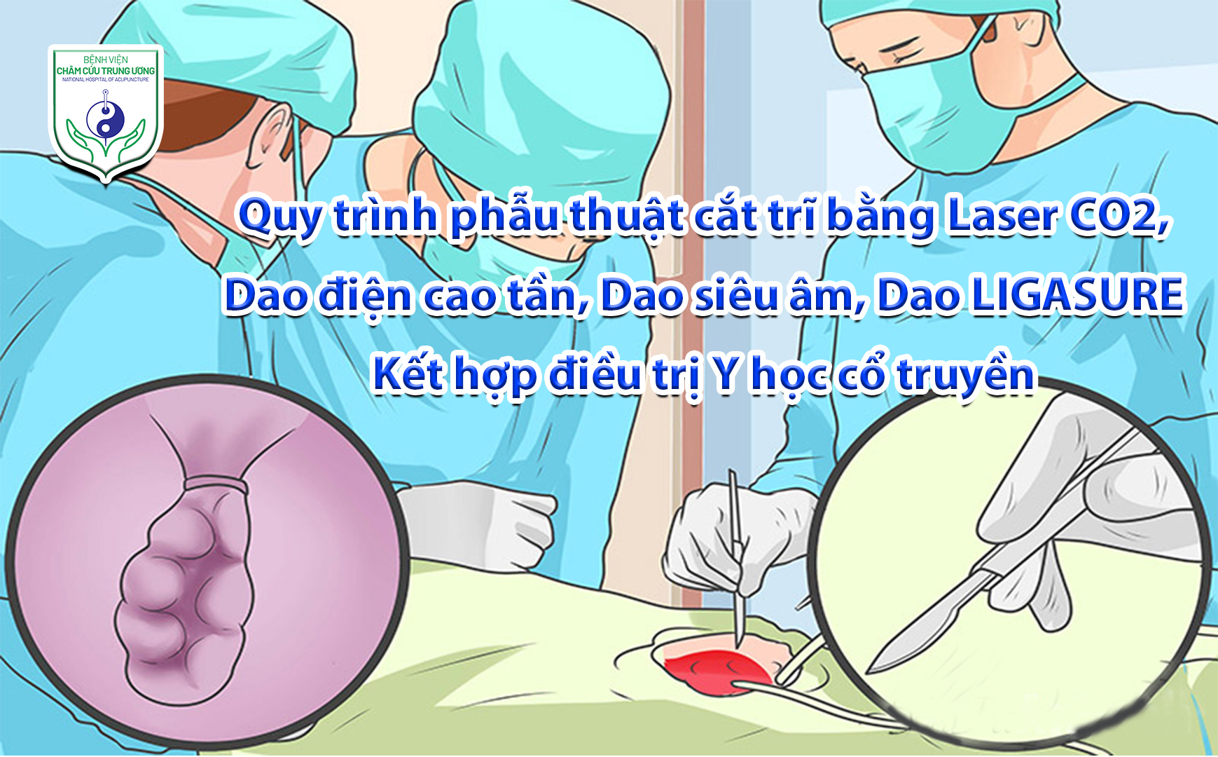 Quy trình phẫu thuật cắt trĩ bằng Laser CO2, Dao điện cao tần, Dao siêu âm, Dao LIGASURE - Kết hợp điều trị Y học cổ truyền