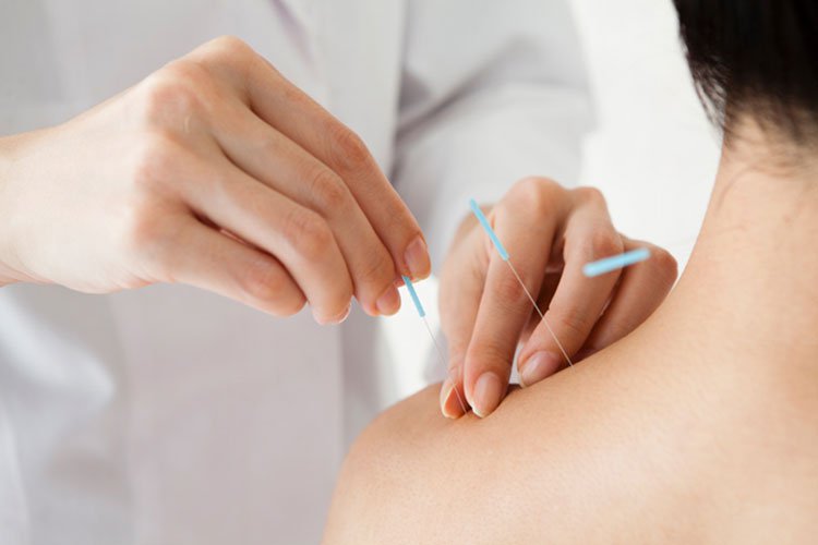 CHÂM CỨU PHƯƠNG PHÁP CHỮA BỆNH HIỆU QUẢ KHÔNG DÙNG THUỐC