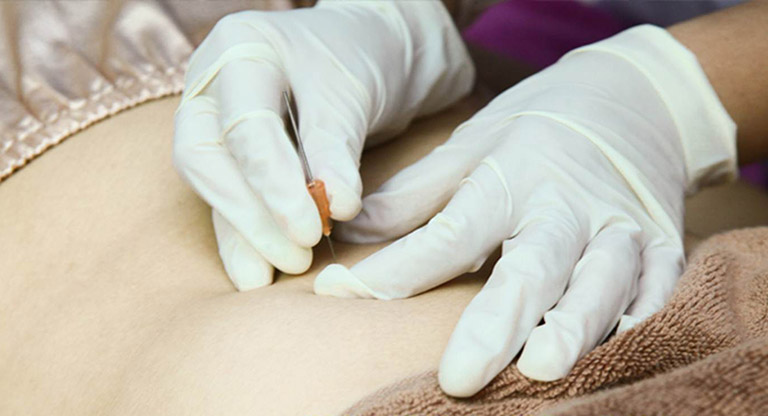 Cấy chỉ điều trị bệnh