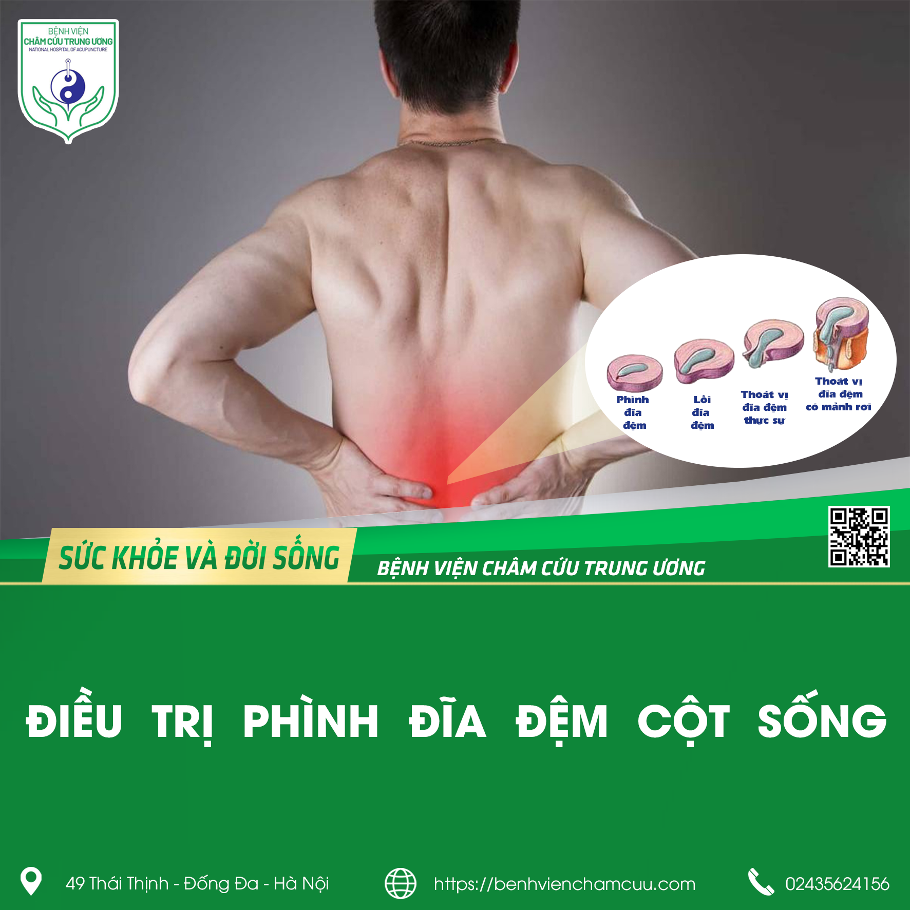 ĐIỀU TRỊ BỆNH PHÌNH ĐĨA ĐỆM CỘT SỐNG