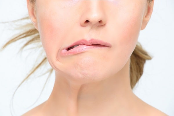 Điều trị liệt thần kinh số VII ngoại biên bằng điện châm kết hợp với chích lễ