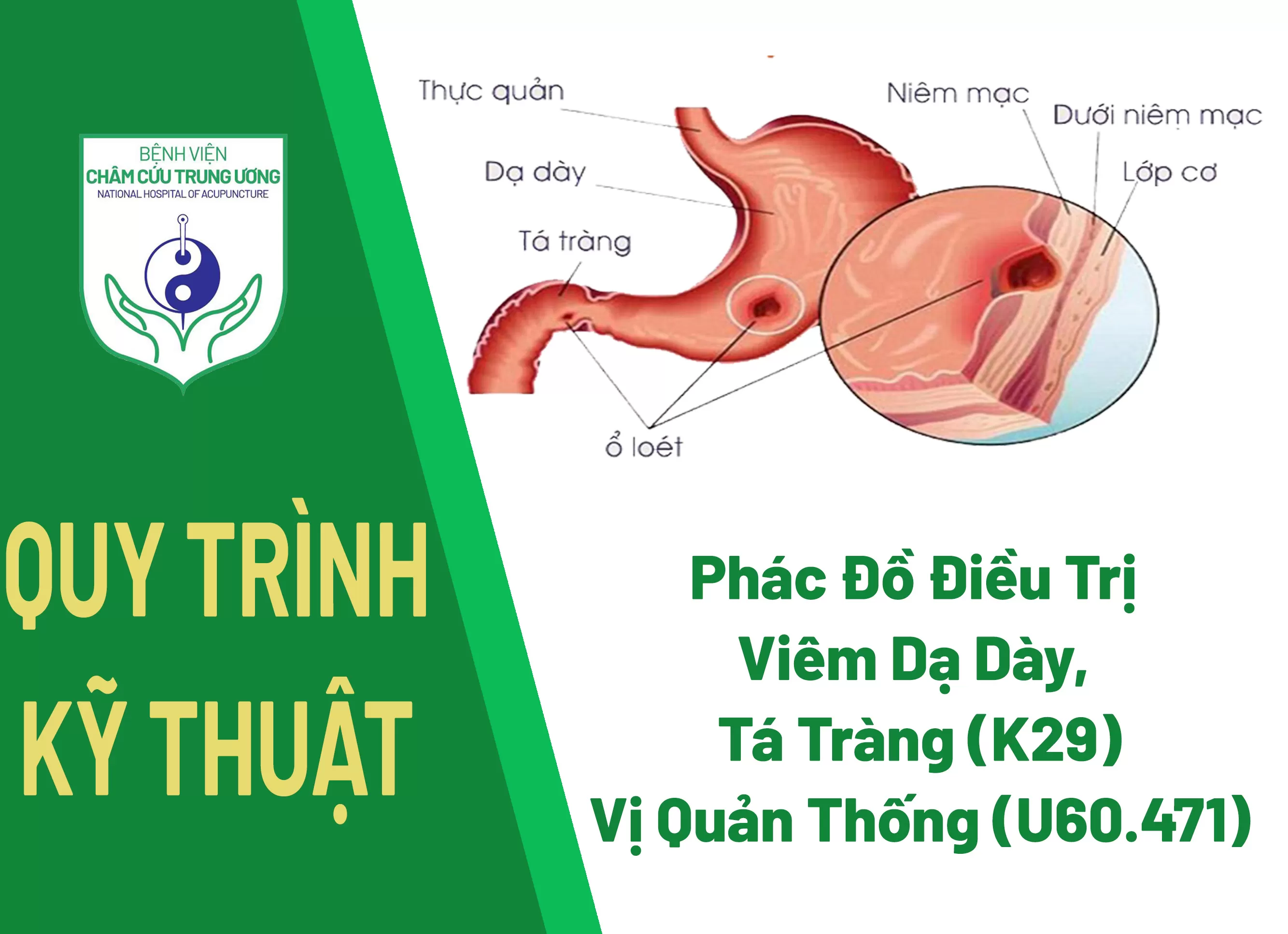 Phác Đồ Điều Trị Viêm Dạ Dày và Tá Tràng (K29) - Vị Quản Thống (U60.471)