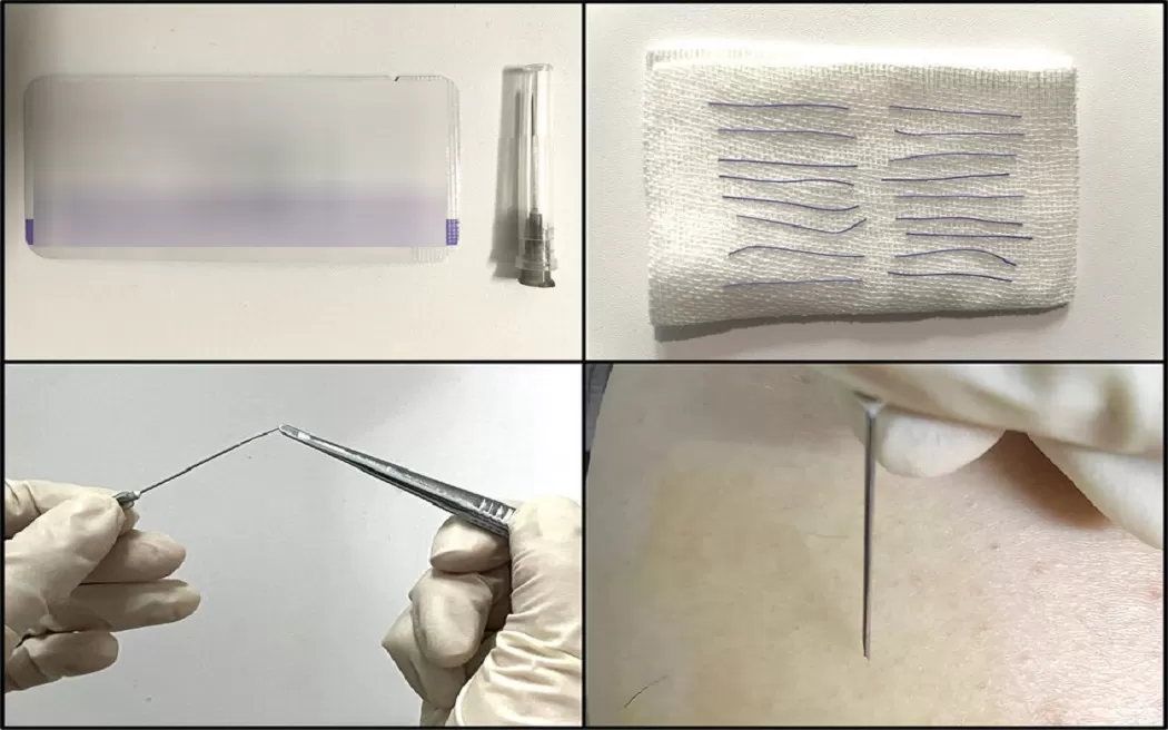 Liệu chữa viêm xoang bằng cấy chỉ có khỏi dứt điểm không? Câu trả lời có tại đây