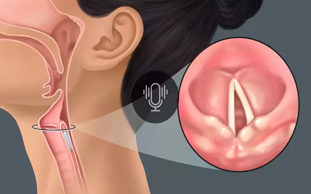 Làm thế nào để biết bị liệt dây thanh và phương pháp điều trị hiệu quả bằng châm cứu