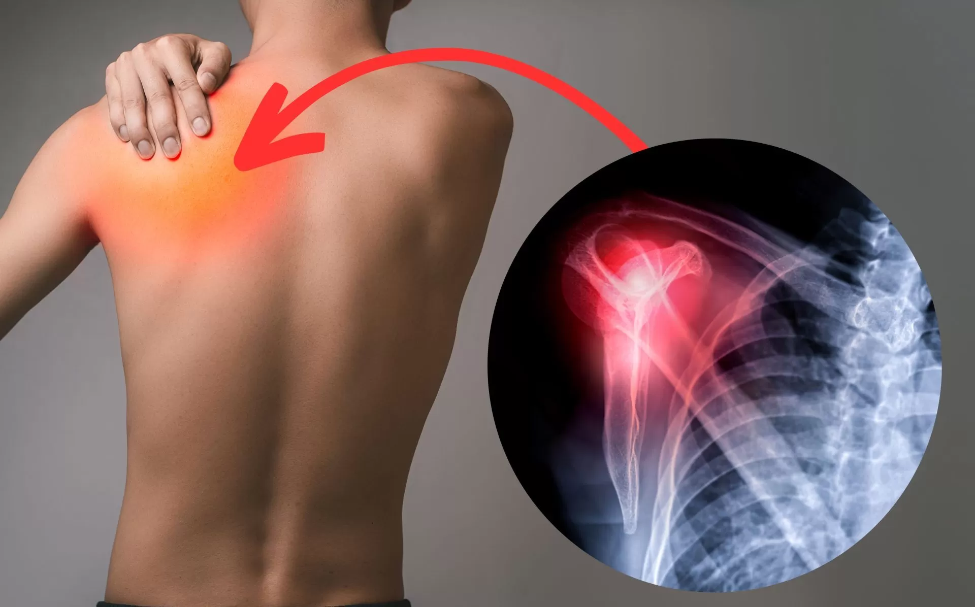 Tại sao điều trị viêm quanh khớp vai bằng châm cứu lại hiệu quả? Câu trả lời có tại đây