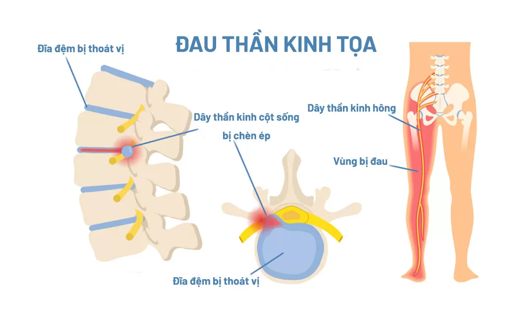 Điều trị đau thần kinh tọa: Phương pháp cụ thể và liệu trình