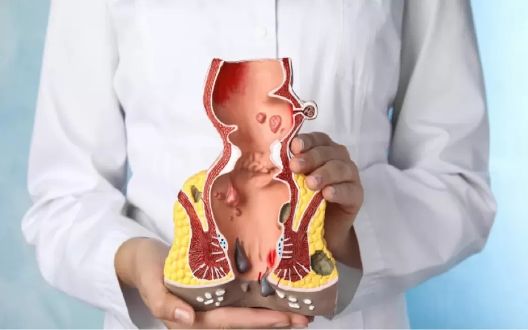 Tiêm xơ búi trĩ là như thế nào và ở đâu thực hiện uy tín? Tìm hiểu tại đây