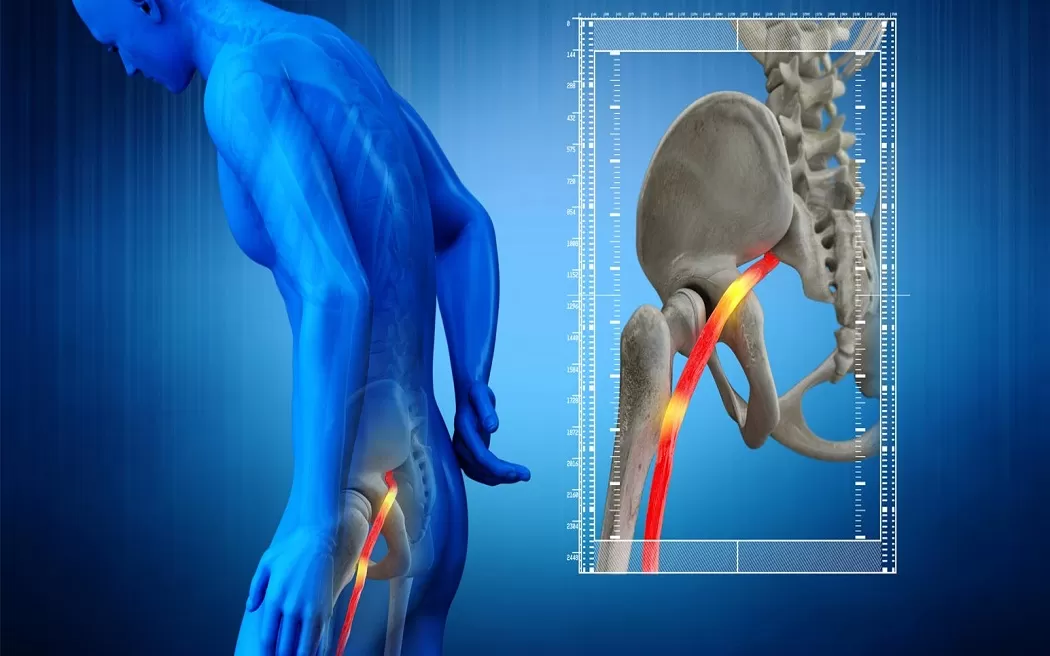 Đau thần kinh toạ là đau ở đâu? Vị trí cụ thể và bài tập giúp giảm đau thần kinh toạ