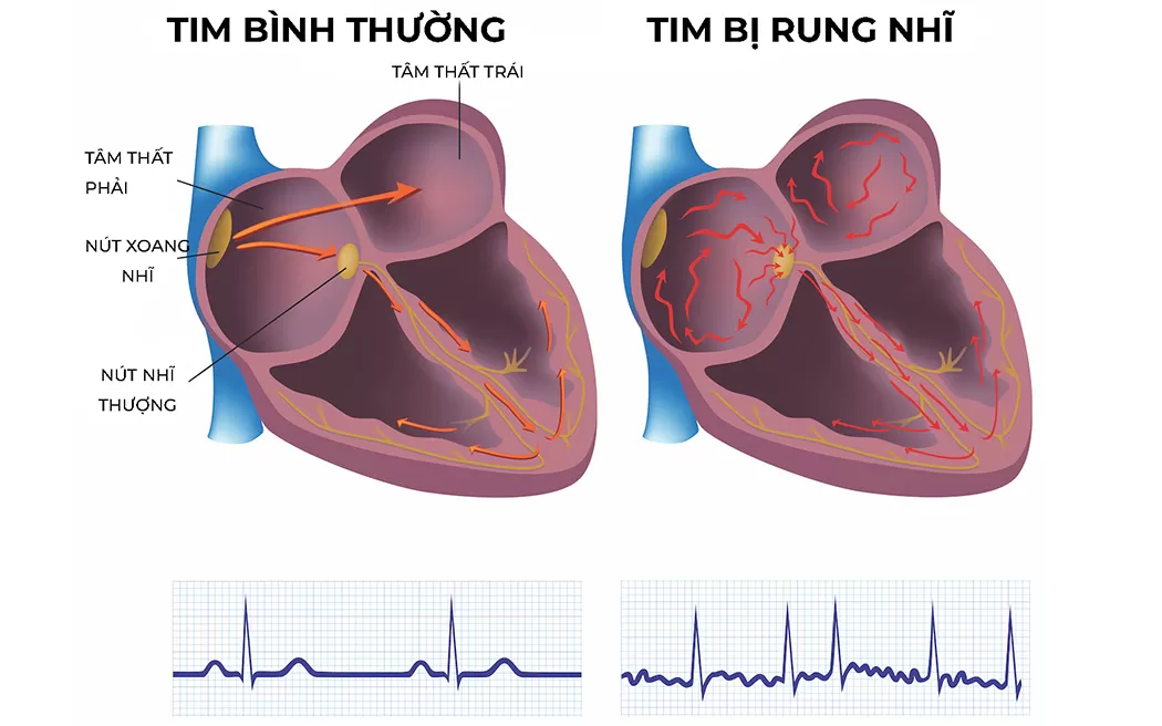 Bệnh rung nhĩ: Có nguy hiểm không, chữa được không và cần làm gì khi phát hiện?